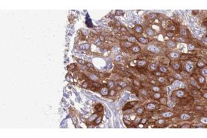 ABIN6276987 at 1/100 staining Human Head and neck cancer tissue by IHC-P.