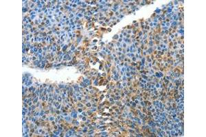 Immunohistochemical analysis of paraffin-embedded Human liver cancer tissue using at dilution 1/25. (ALPK1 anticorps  (C-Term))