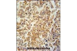 TEX9 antibody (N-term) (ABIN654569 and ABIN2844274) immunohistochemistry analysis in formalin fixed and paraffin embedded human testis carcinoma followed by peroxidase conjugation of the secondary antibody and DAB staining. (TEX9 anticorps  (N-Term))