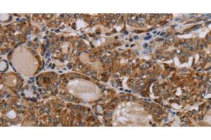 Immunohistochemistry of paraffin-embedded Human thyroid cancer tissue using MT-ND6 Polyclonal Antibody at dilution 1:40 (MT-ND6 anticorps)
