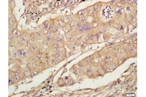 Formalin-fixed and paraffin embedded human lung carcinoma labeled with Anti-CD44 Polyclonal Antibody, Unconjugated  at 1:200 followed by conjugation to the secondary antibody and DAB staining