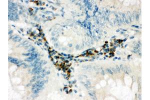 Anti-SPARCL1 antibody, IHC(P) IHC(P): Human Intestinal Cancer Tissue (SPARCL1 anticorps  (C-Term))