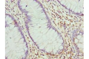 Immunohistochemistry of paraffin-embedded human colon cancer using ABIN7168234 at dilution of 1:100
