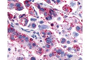 Anti-GPR4 antibody IHC of human Lung, Adenocarcinoma.