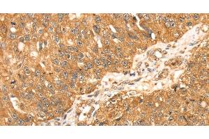 Immunohistochemistry of paraffin-embedded Human breast cancer using ERK 5 Polyclonal Antibody at dilution of 1:35 (MAPK7 anticorps)