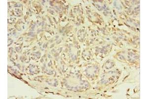 Immunohistochemistry of paraffin-embedded human breast cancer using ABIN7143952 at dilution of 1:100 (ABHD14A anticorps  (AA 56-258))