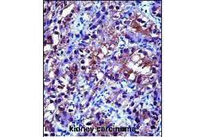 CRYA Antibody (Center) (ABIN657620 and ABIN2846616) immunohistochemistry analysis in formalin fixed and paraffin embedded human kidney carcinoma followed by peroxidase conjugation of the secondary antibody and DAB staining. (CRYAB anticorps  (AA 84-112))