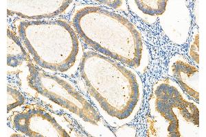ABIN6265225 and ABIN6277101 at 1/100 staining human ovarian cancer by IHC-P. (SORD anticorps  (Internal Region))