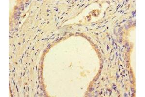 Immunohistochemistry of paraffin-embedded human prostate cancer using ABIN7149526 at dilution of 1:100 (DCAF8 anticorps  (AA 1-135))