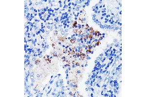Immunohistochemistry of paraffin-embedded human lung cancer using BTK Rabbit mAb (ABIN7265950) at dilution of 1:100 (40x lens).