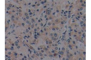 Detection of TLR9 in Human Prostate cancer Tissue using Polyclonal Antibody to Toll Like Receptor 9 (TLR9)