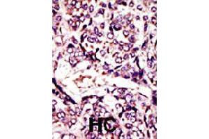 Formalin-fixed and paraffin-embedded human hepatocellular carcinoma tissue reacted with ARL1 polyclonal antibody  , which was peroxidase-conjugated to the secondary antibody, followed by DAB staining . (ARL1 anticorps  (N-Term))