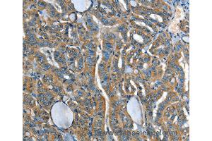 Immunohistochemistry of Human liver cancer using ADCY4 Polyclonal Antibody at dilution of 1:45 (ADCY4 anticorps)