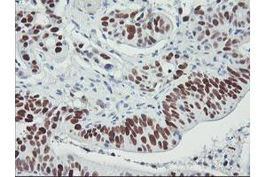 Immunohistochemistry (IHC) image for anti-Tumor Protein P53 (TP53) antibody (ABIN1499970) (p53 anticorps)