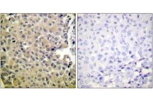 Immunohistochemistry analysis of paraffin-embedded human breast carcinoma, using PP1-alpha (Phospho-Thr320) Antibody. (PPP1CA anticorps  (pThr320))