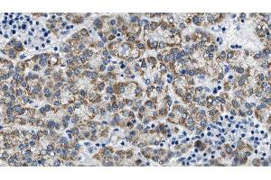 ABIN6275089 at 1/100 staining Human liver cancer tissue by IHC-P. (MYLIP anticorps  (Internal Region))