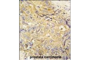 Formalin-fixed and paraffin-embedded human prostata carcinoma tissue reacted with FGF10 antibody (C-term) (ABIN392510 and ABIN2842073) , which was peroxidase-conjugated to the secondary antibody, followed by DAB staining. (FGF10 anticorps  (C-Term))