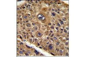 Formalin-Fixed, Paraffin-Eembedded Human hepatocarcinoma reacted with TOB1 Antibody (N-term), which was peroxidase-conjugated to the secondary antibody, followed by DAB staining.
