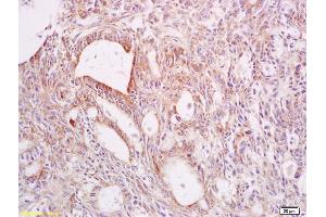 Formalin-fixed and paraffin embedded human rectal carcinoma labeled with Anti-CYP2C9 Polyclonal Antibody, Unconjugated (ABIN681208) at 1:200 followed by conjugation to the secondary antibody and DAB staining