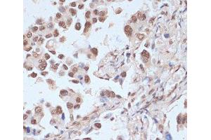 Immunohistochemistry of paraffin-embedded Human lung cancer using Phospho-PRKAA1(T183)/PRKAA2(T172) Polyclonal Antibody at dilution of 1:100 (40x lens).