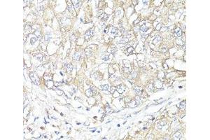 Immunohistochemistry of paraffin-embedded Human liver cancer using ATP1B1 Polyclonal Antibody at dilution of 1:100 (40x lens). (ATP1B1 anticorps)