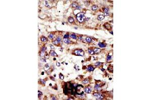 Formalin-fixed and paraffin-embedded human hepatocellular carcinoma tissue reacted with ZMPSTE24 polyclonal antibody  , which was peroxidase-conjugated to the secondary antibody, followed by DAB staining . (ZMPSTE24 anticorps  (C-Term))