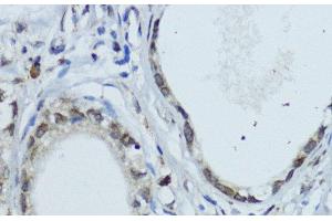 Immunohistochemistry of paraffin-embedded Human gastric cancer using NR1I3 Polyclonal Antibody at dilution of 1:200 (40x lens). (NR1I3 anticorps)