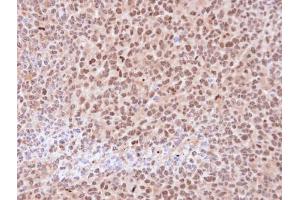 IHC-P Image Immunohistochemical analysis of paraffin-embedded H1299 xenograft , using 20S Proteasome alpha6 , antibody at 1:100 dilution.