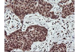 Immunohistochemical staining of paraffin-embedded Carcinoma of Human lung tissue using anti-PDE4B mouse monoclonal antibody. (PDE4B anticorps)