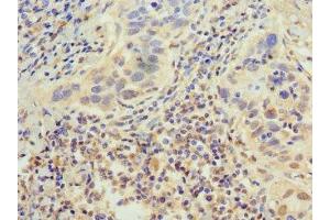 Immunohistochemistry of paraffin-embedded human bladder cancer using ABIN7155286 at dilution of 1:100