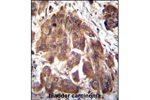 GLMN Antibody (C-term) (ABIN655986 and ABIN2845370) immunohistochemistry analysis in formalin fixed and paraffin embedded human bladder carcinoma followed by peroxidase conjugation of the secondary antibody and DAB staining. (GLMN anticorps  (C-Term))