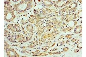 Immunohistochemistry of paraffin-embedded human breast cancer using ABIN7171432 at dilution of 1:100 (CCT6A anticorps  (AA 80-250))