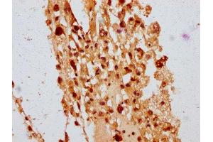 IHC image of ABIN7150243 diluted at 1:400 and staining in paraffin-embedded human melanoma performed on a Leica BondTM system. (POLE4 anticorps  (AA 8-117))