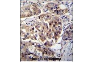 hCG_1995004 Antibody (Center) (ABIN655542 and ABIN2850483) immunohistochemistry analysis in formalin fixed and paraffin embedded human breast carcinoma followed by peroxidase conjugation of the secondary antibody and DAB staining. (hCG_1995004 (AA 116-144) anticorps)