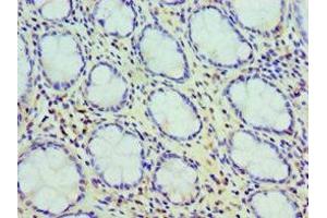Immunohistochemistry of paraffin-embedded human colon cancer using ABIN7147595 at dilution of 1:100 (Cholecystokinin anticorps  (AA 21-115))