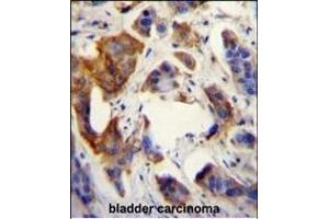 UBFD1 antibody (N-term) (ABIN655026 and ABIN2844657) immunohistochemistry analysis in formalin fixed and paraffin embedded human bladder carcinoma followed by peroxidase conjugation of the secondary antibody and DAB staining.
