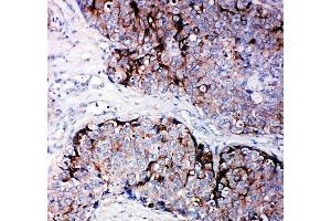 Anti-TIMP2 antibody, (ABIN3044332), IHC(P)IHC(P): Human Mammary Cancer Tissue