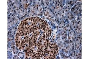 Immunohistochemical staining of paraffin-embedded Adenocarcinoma of colon tissue using anti-SRR mouse monoclonal antibody. (SRR anticorps)