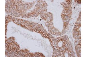 IHC-P Image Immunohistochemical analysis of paraffin-embedded human colon carcinoma, using PNPase, antibody at 1:250 dilution.