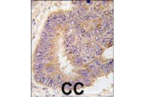 Formalin-fixed and paraffin-embedded human colon carcinoma tissue reacted with PDE8A antibody (L572), which was peroxidase-conjugated to the secondary antibody, followed by DAB staining. (PDE8A anticorps  (AA 557-587))