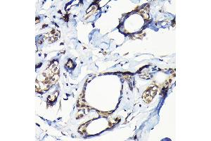 Immunohistochemistry of paraffin-embedded human breast cancer using USP5 Rabbit pAb (ABIN1683231, ABIN3018687, ABIN3018688 and ABIN6220542) at dilution of 1:100 (40x lens).