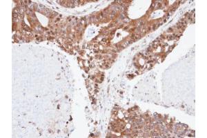 IHC-P Image Immunohistochemical analysis of paraffin-embedded human endo mitral ovarian cancer, using ERLIN2, antibody at 1:100 dilution. (ERLIN2 anticorps  (C-Term))