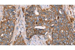 Immunohistochemistry of paraffin-embedded Human cervical cancer using FUCA1 Polyclonal Antibody at dilution of 1:30