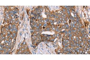 Immunohistochemistry of paraffin-embedded Human cervical cancer using FUCA1 Polyclonal Antibody at dilution of 1:30 (FUCA1 anticorps)