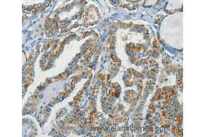 Immunohistochemistry of Human thyroid cancer using NPAP1 Polyclonal Antibody at dilution of 1:70 (NPAP1 anticorps)