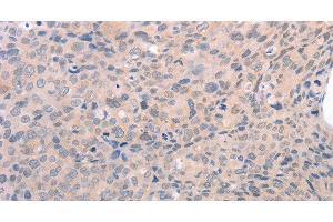 Immunohistochemistry of paraffin-embedded Human cervical cancer using EDG3 Polyclonal Antibody at dilution of 1:30 (S1PR3 anticorps)