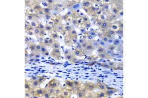 Immunohistochemistry of paraffin-embedded human liver injury using PSMD8 antibody at dilution of 1:100 (x40 lens). (PSMD8 anticorps)