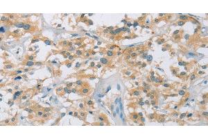 Immunohistochemistry of paraffin-embedded Human thyroid cancer tissue using CYP11B1 Polyclonal Antibody at dilution 1:30 (CYP11B1 anticorps)