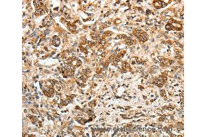 Immunohistochemistry of Human gastric cancer using CALR Polyclonal Antibody at dilution of 1:30 (Calreticulin anticorps)