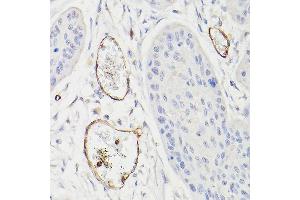 Immunohistochemistry of paraffin-embedded human esophageal cancer using CD34 Rabbit pAb (ABIN6134661, ABIN6138169, ABIN6138171 and ABIN6218103) at dilution of 1:100 (40x lens). (CD34 anticorps  (C-Term))